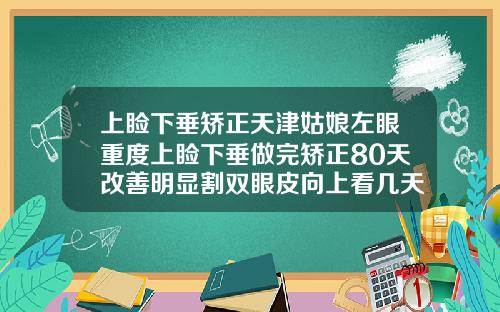 上睑下垂矫正天津姑娘左眼重度上睑下垂做完矫正80天改善明显割双眼皮向上看几天能恢复
