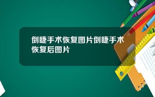 倒睫手术恢复图片倒睫手术恢复后图片
