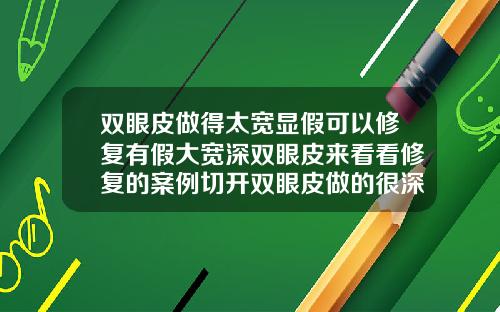 双眼皮做得太宽显假可以修复有假大宽深双眼皮来看看修复的案例切开双眼皮做的很深能修复吗