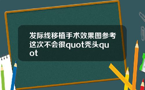 发际线移植手术效果图参考这次不会很quot秃头quot