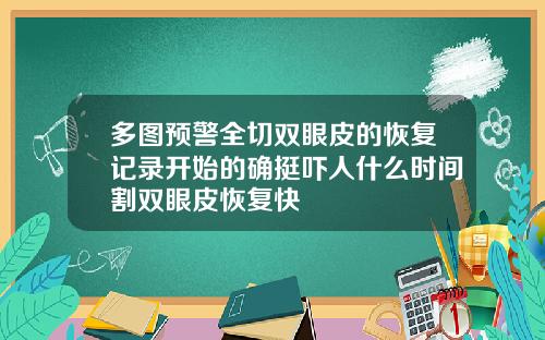 多图预警全切双眼皮的恢复记录开始的确挺吓人什么时间割双眼皮恢复快