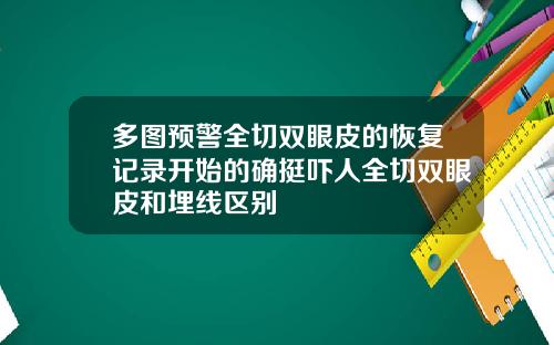 多图预警全切双眼皮的恢复记录开始的确挺吓人全切双眼皮和埋线区别