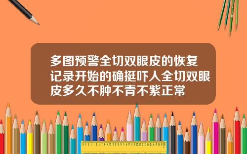 多图预警全切双眼皮的恢复记录开始的确挺吓人全切双眼皮多久不肿不青不紫正常