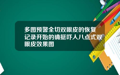 多图预警全切双眼皮的恢复记录开始的确挺吓人八点式双眼皮效果图