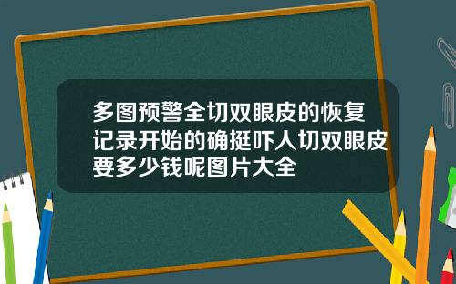 多图预警全切双眼皮的恢复记录开始的确挺吓人切双眼皮要多少钱呢图片大全