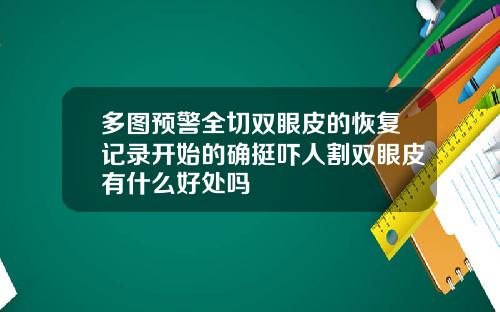 多图预警全切双眼皮的恢复记录开始的确挺吓人割双眼皮有什么好处吗