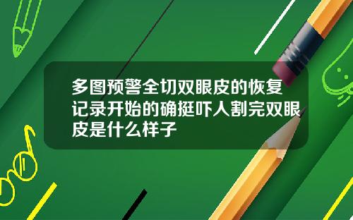 多图预警全切双眼皮的恢复记录开始的确挺吓人割完双眼皮是什么样子