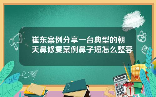 崔东案例分享一台典型的朝天鼻修复案例鼻子短怎么整容