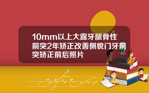 10mm以上大露牙龈骨性前突2年矫正改善侧貌门牙前突矫正前后照片