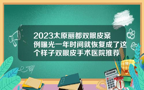 2023太原丽都双眼皮案例曝光一年时间就恢复成了这个样子双眼皮手术医院推荐