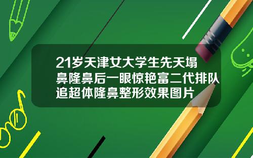 21岁天津女大学生先天塌鼻隆鼻后一眼惊艳富二代排队追超体隆鼻整形效果图片