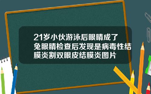 21岁小伙游泳后眼睛成了兔眼睛检查后发现是病毒性结膜炎割双眼皮结膜炎图片